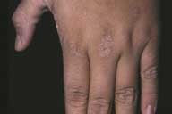 Picture of acanthosis nigricans on the hand